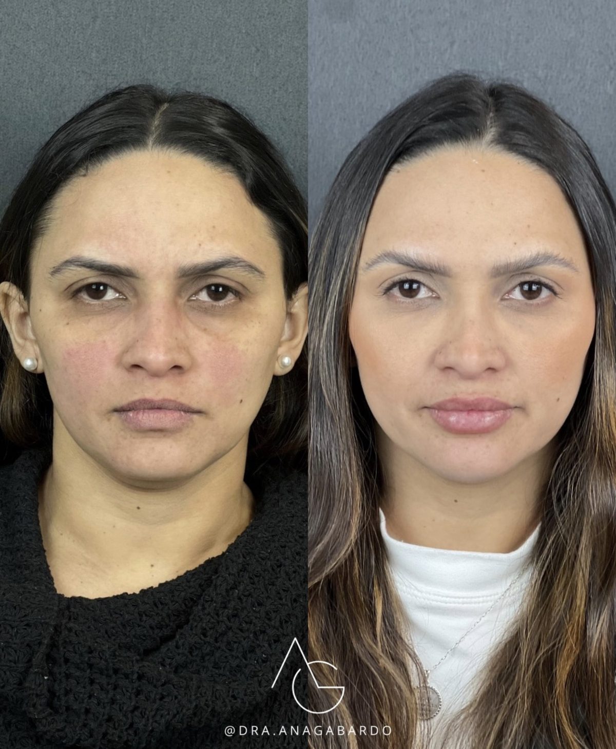 Antes e depois de harmonização fullface, frente