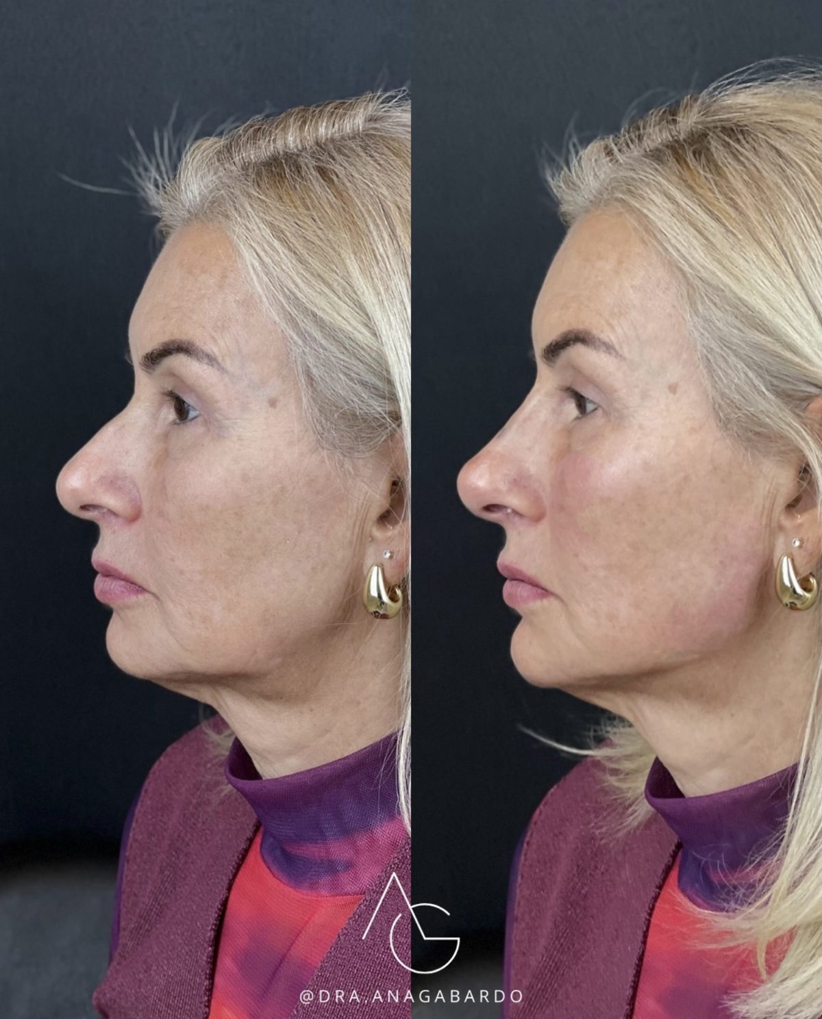 Antes e depois de harmonização fullface, perfil