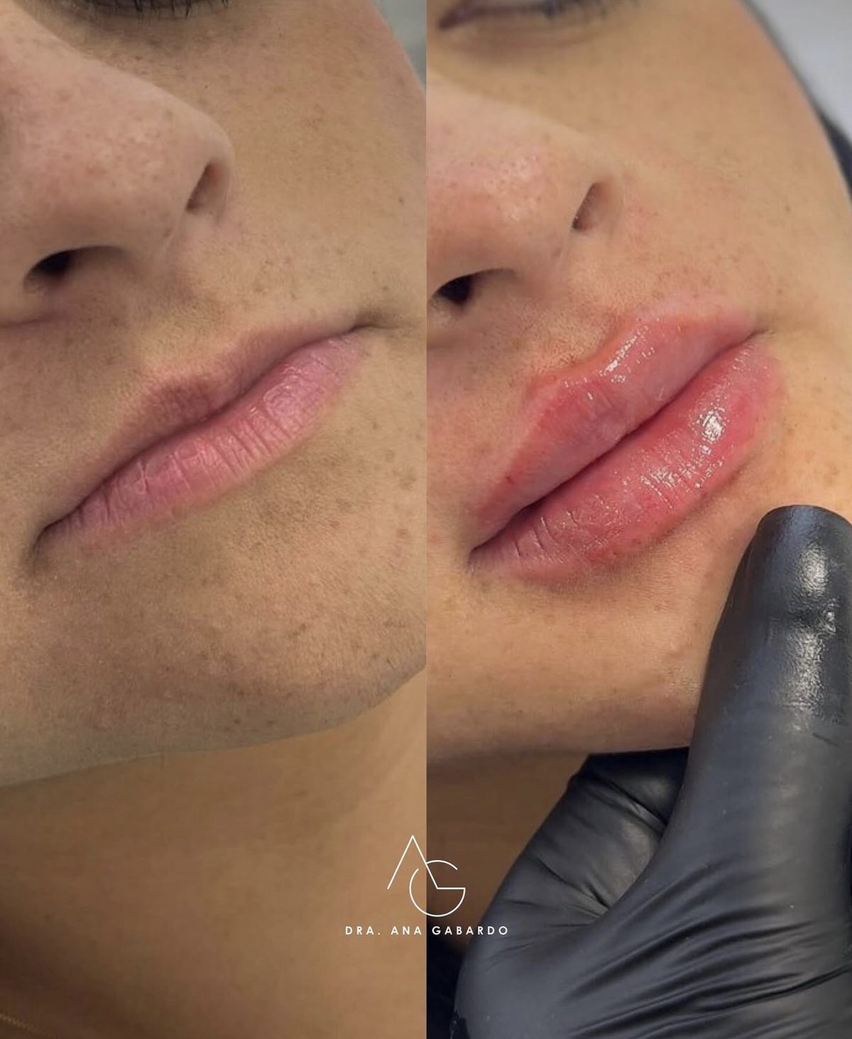 Antes e depois de preenchimento labial