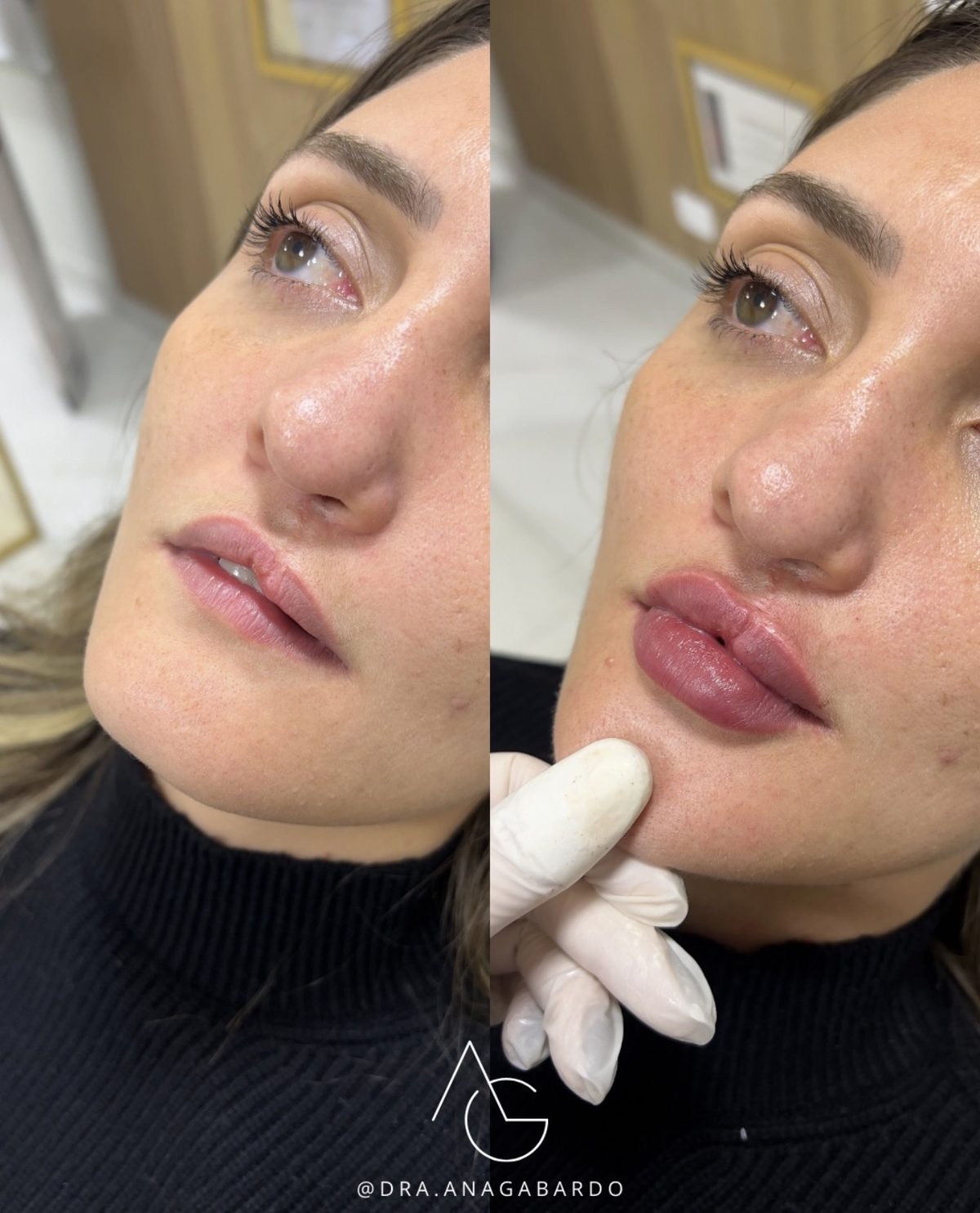 Antes e depois de preenchimento em lábio leporino